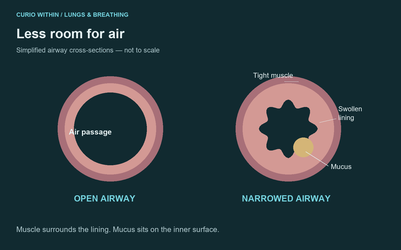 Simplified comparison of an open airway and an airway narrowed by tight muscle, thickened lining and mucus.