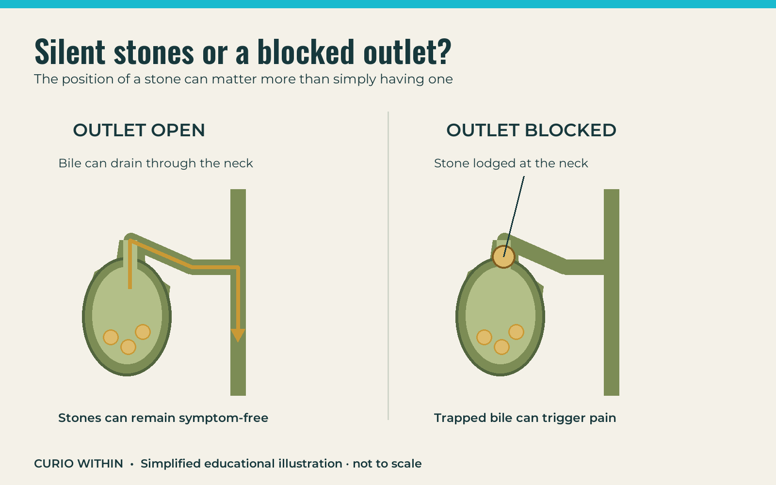 Comparison of gallstones resting away from an open outlet and a stone blocking the gallbladder neck