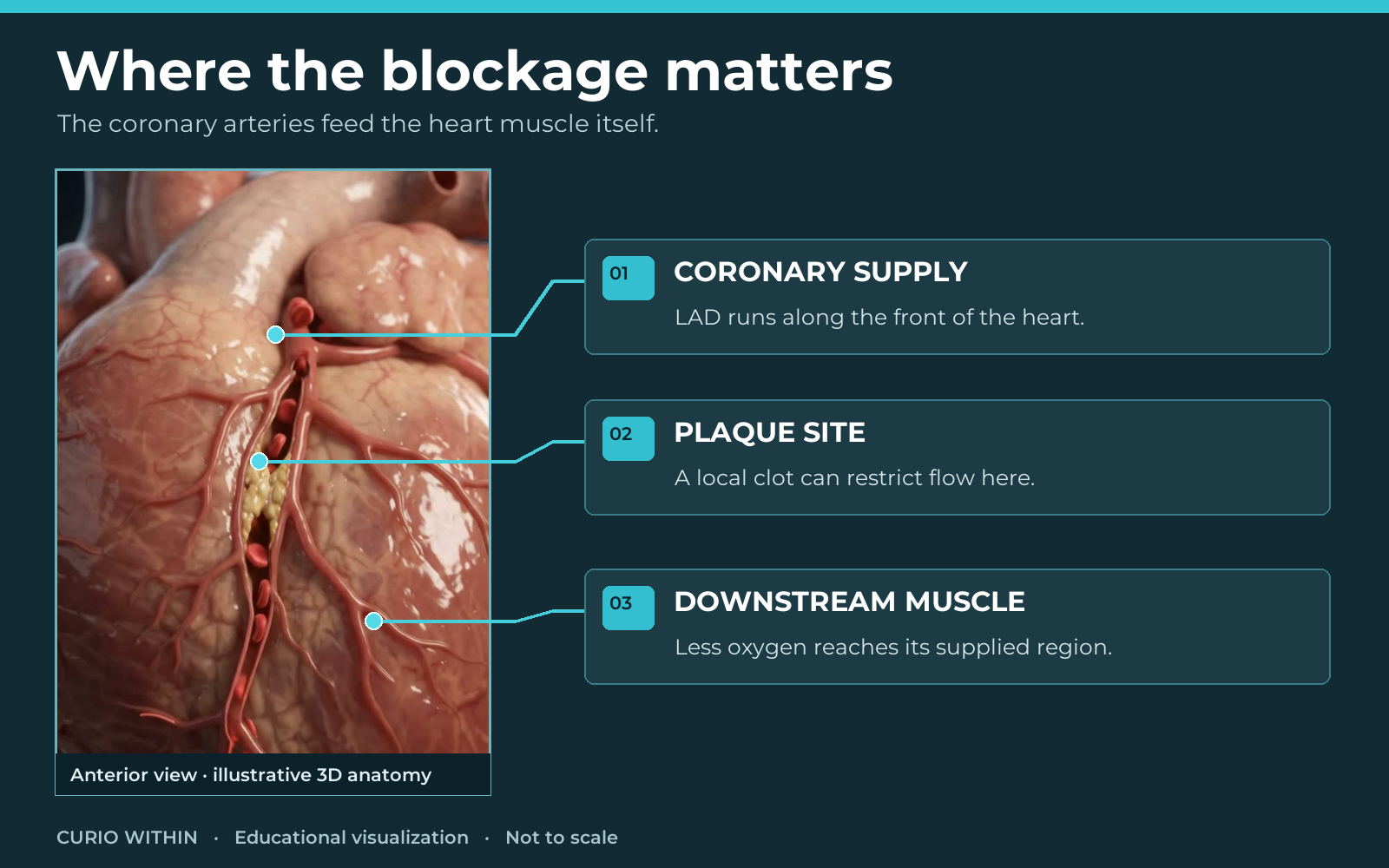 Illustrative anterior heart view identifying coronary supply, a plaque site and downstream muscle