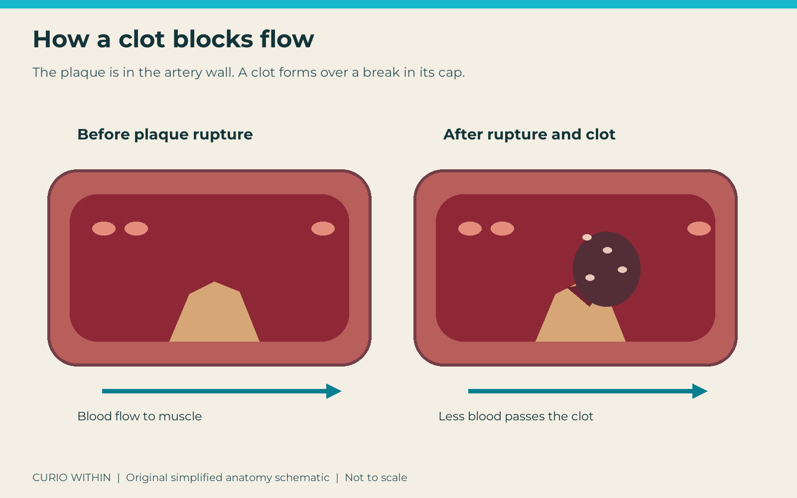 Two simplified artery sections comparing plaque within the wall before rupture and a clot over the plaque with reduced downstream blood flow
