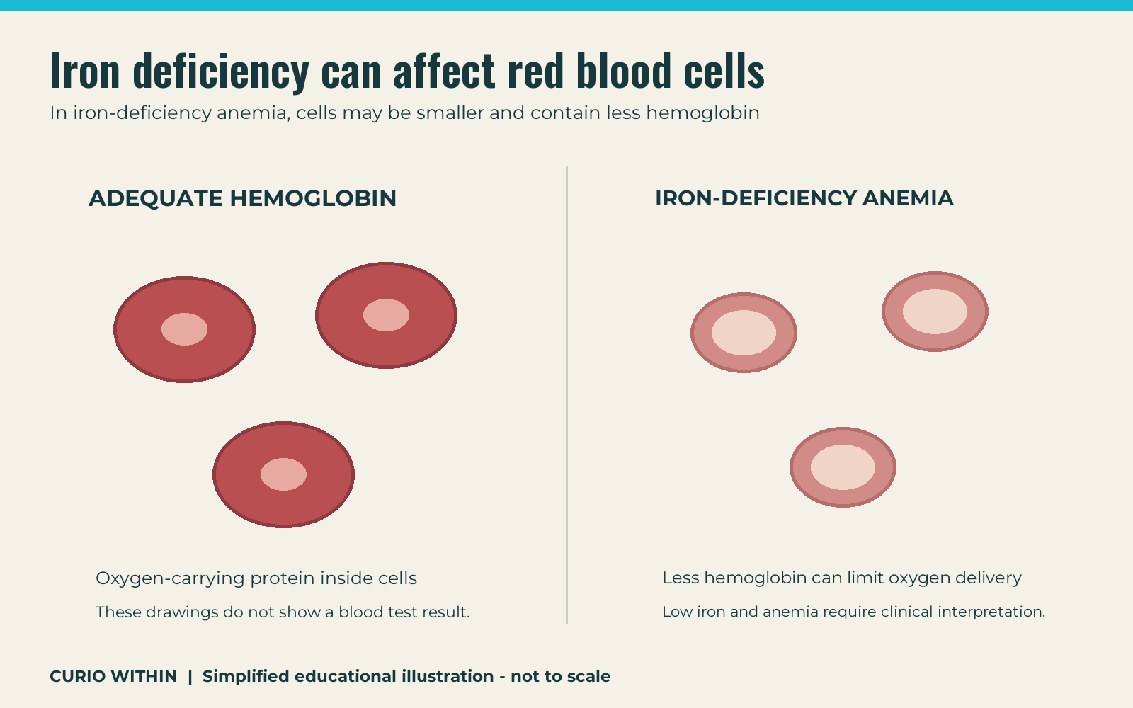 Illustrative comparison of red cells with adequate hemoglobin and smaller paler cells in iron-deficiency anemia