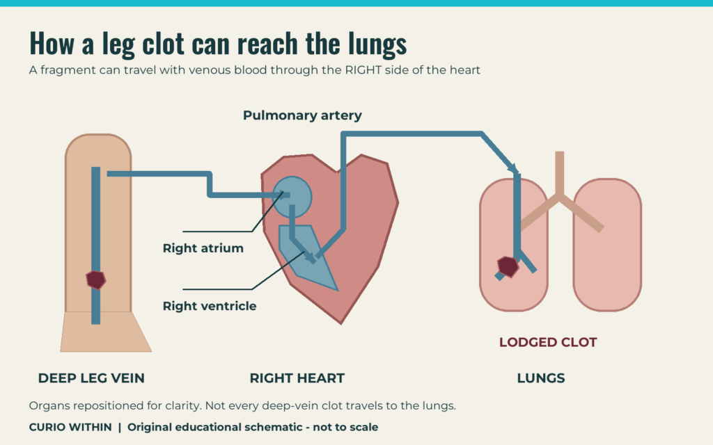 How a leg blood clot can travel to the lungs: pulmonary embolism explained
