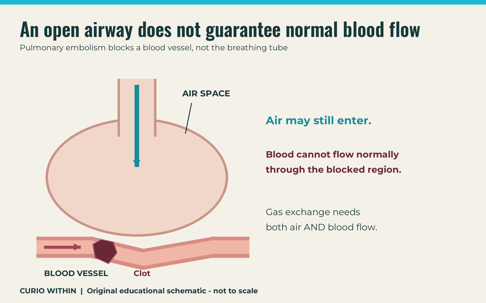 An open lung air space beside a blood vessel obstructed by a clot, showing that ventilation and blood flow are separate