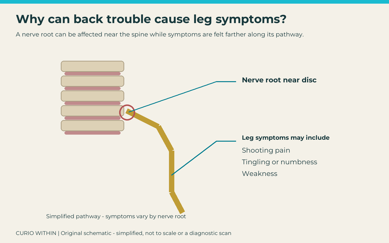 Schematic lumbar spine and nerve pathway linking a nerve root near a disc with possible shooting leg pain, tingling, numbness or weakness