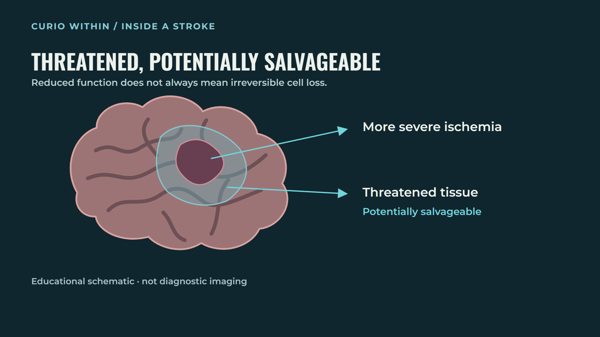 Irregular illustrative perfusion zones showing a more severely affected region and surrounding threatened, potentially salvageable tissue
