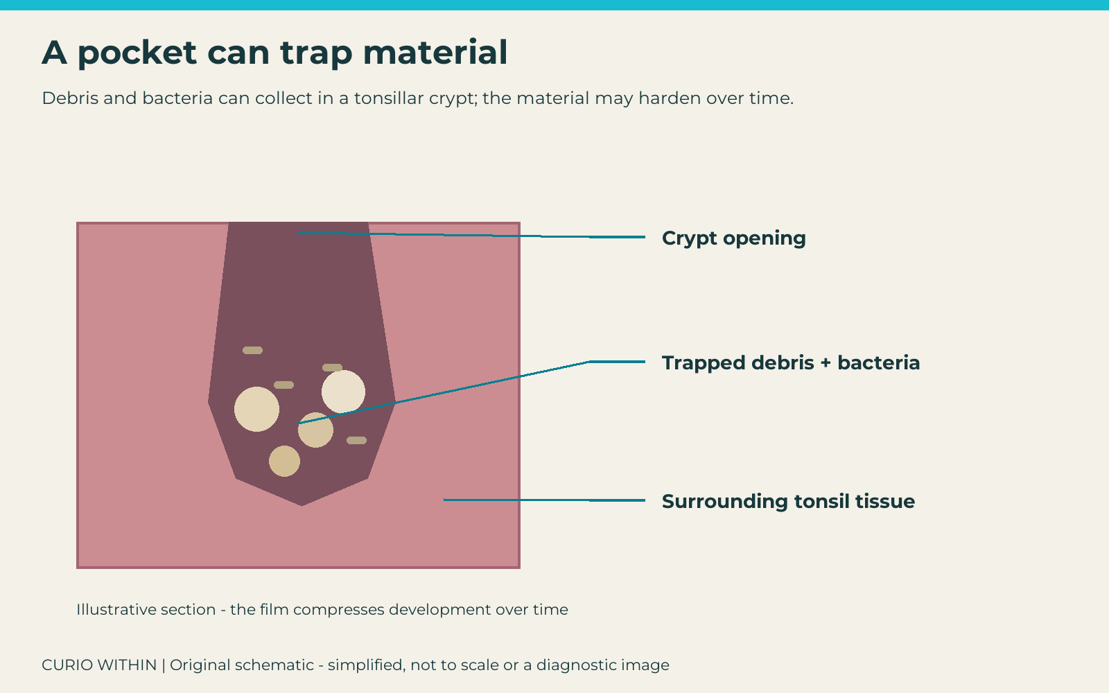 Section through a tonsillar crypt showing its surface opening, trapped debris and bacteria, and surrounding tonsil tissue