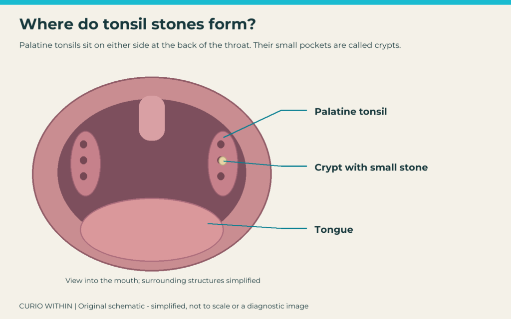 Tonsil stones: what are the small white lumps at the back of the throat?