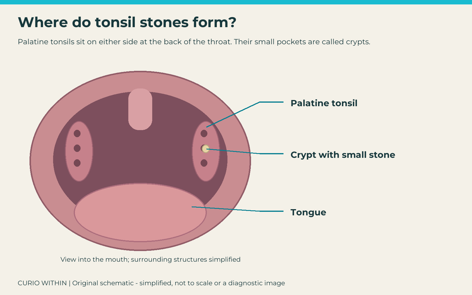 Simplified view into the mouth showing the palatine tonsils, a small stone in a tonsillar crypt, and the tongue