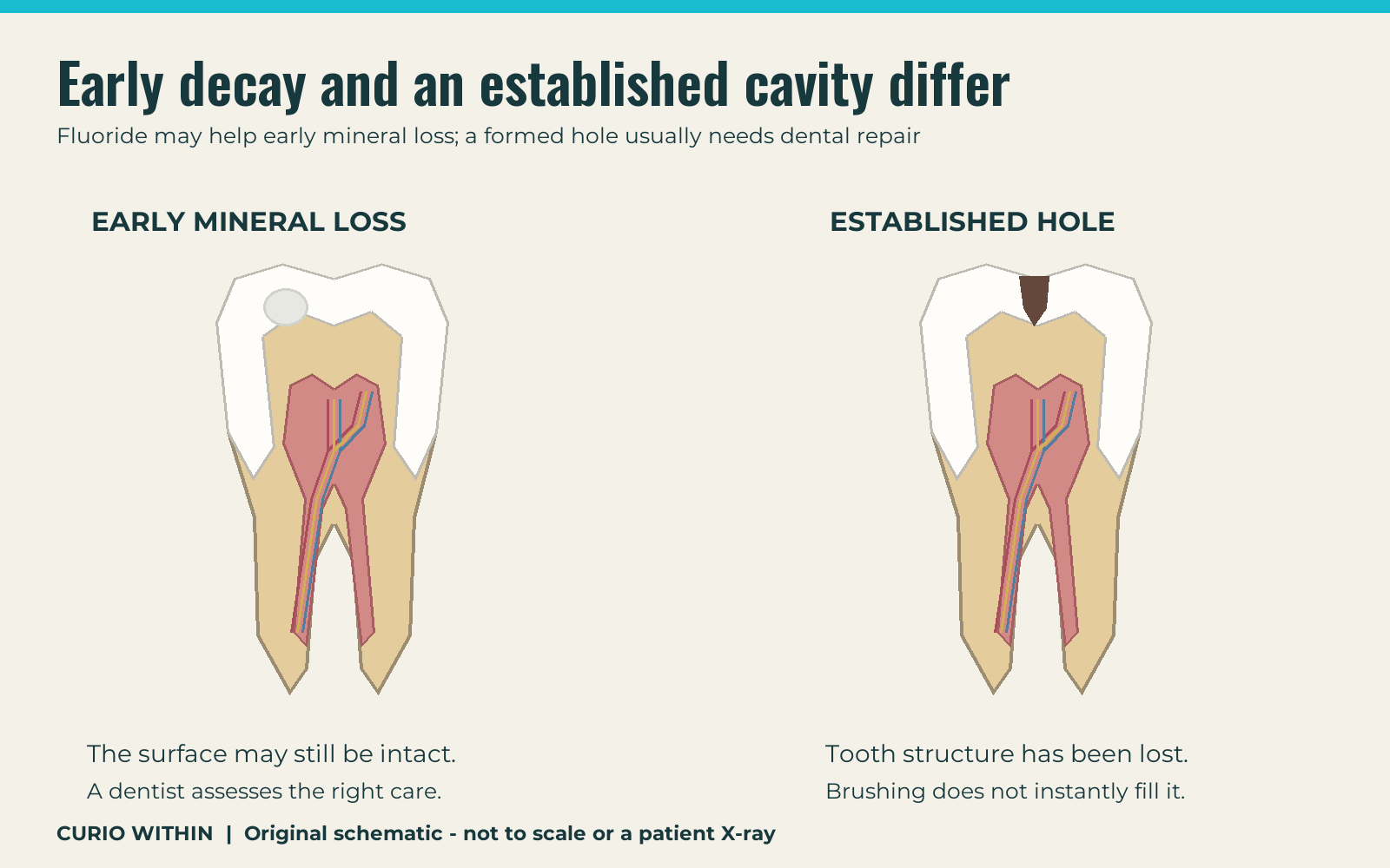 Comparison of an intact enamel surface with early mineral loss and a tooth with an established cavity