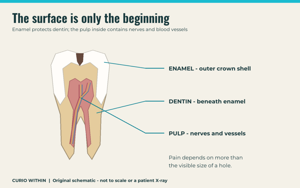 Why a small cavity can cause a big toothache